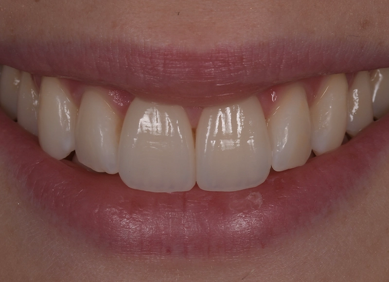 Faccette dentali Brescia - Poliambulatorio Magellano - Cosa facciamo